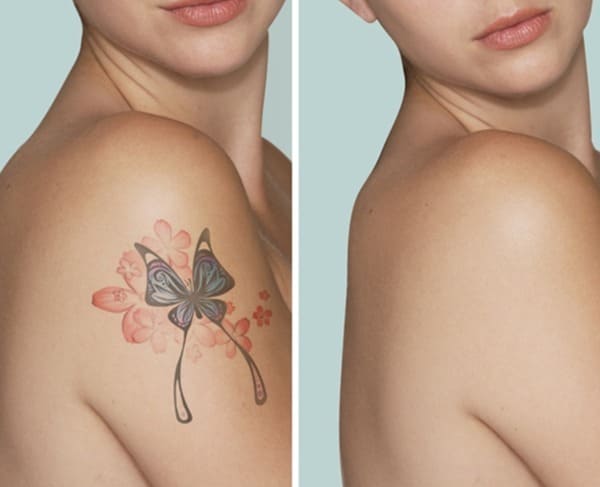 Tattoo Removal